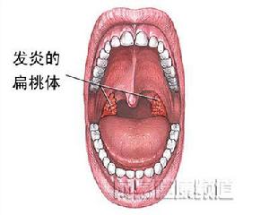 扁桃體炎