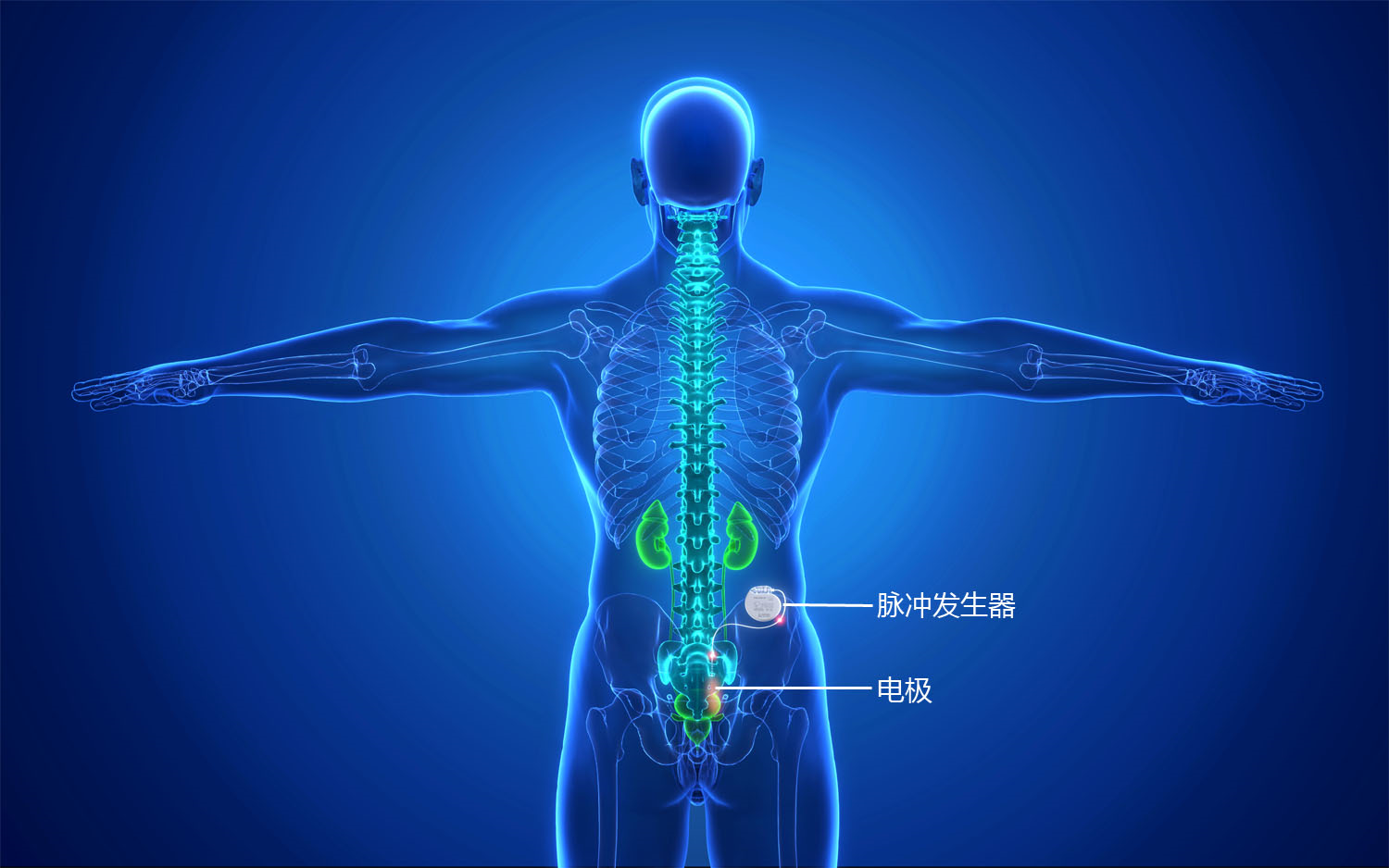 骶神經刺激器