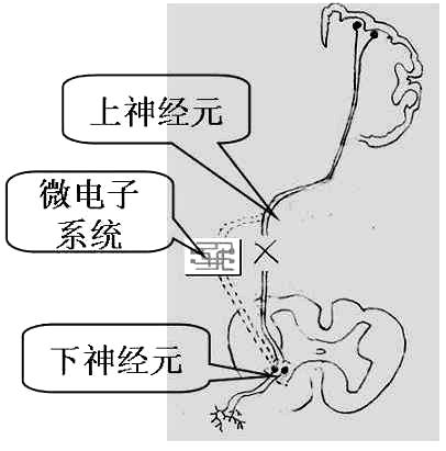 植入式微電子神經橋