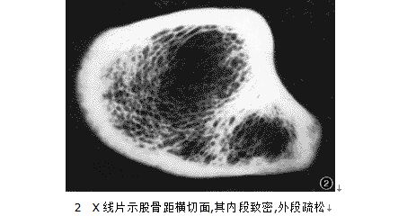 股骨距橫斷面