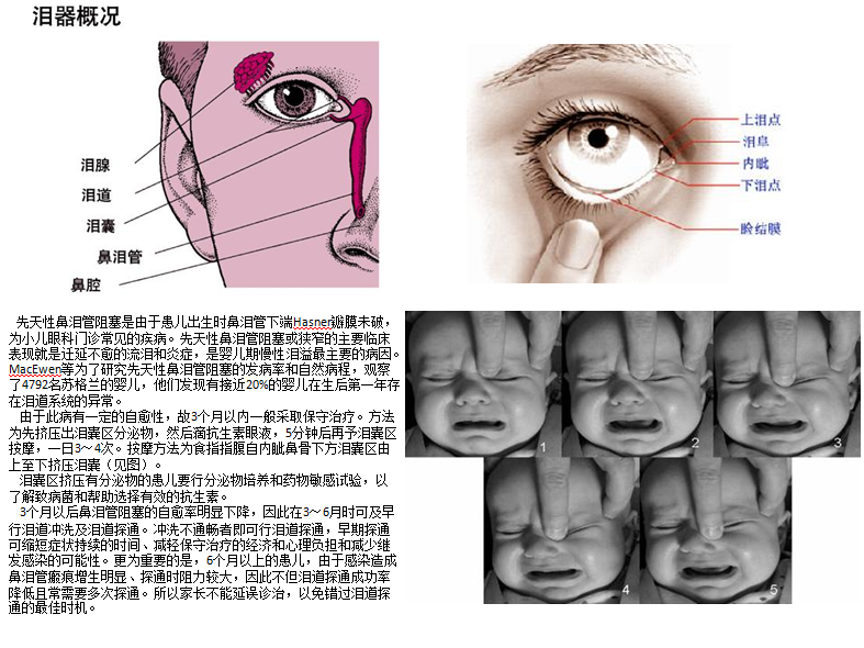 鼻淚管堵塞