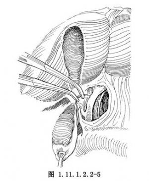 逆行膽囊切除術