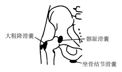 (圖1)髖部滑囊