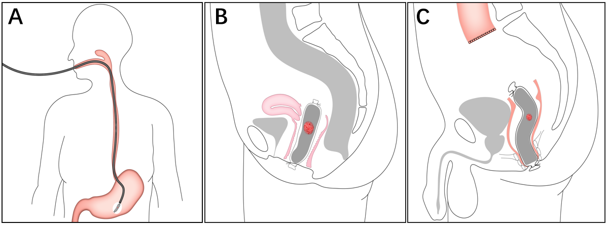 經自然腔道取標本手術