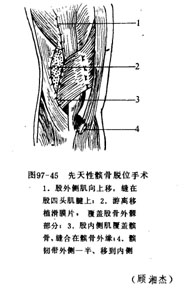 先天性髕骨脫位