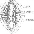 椎管內腫瘤切除術