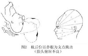 持續性枕後位難產