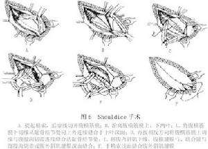 成人腹股溝斜疝(三)