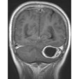 顱內併發症-耳源性腦膿腫