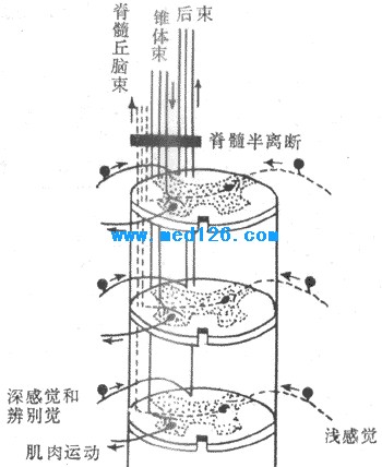 延髓空洞症