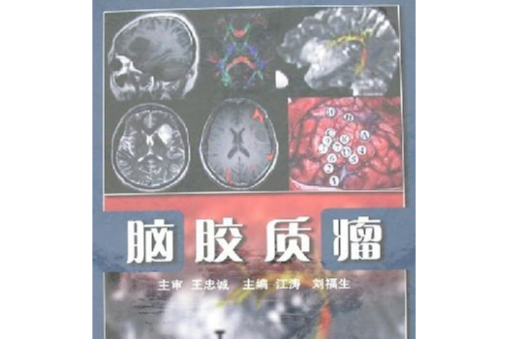 腦膠質瘤(2007年人民衛生出版社出版的圖書)