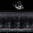 超聲心動圖(UCG（心動圖）)