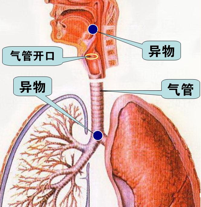 急性呼吸道堵塞