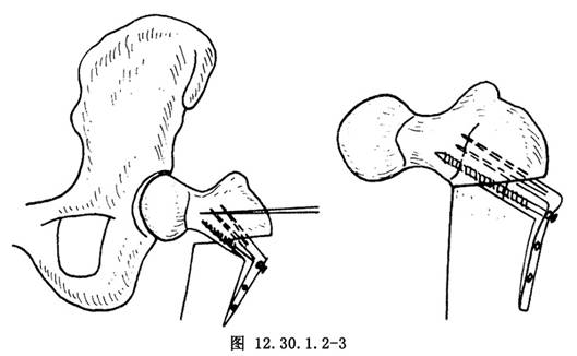 股骨粗隆下截骨術