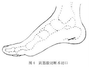 脊髓前角灰質炎