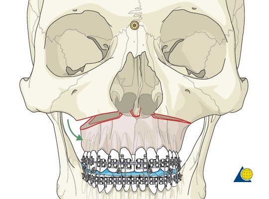 上頜骨LefortI型前移術