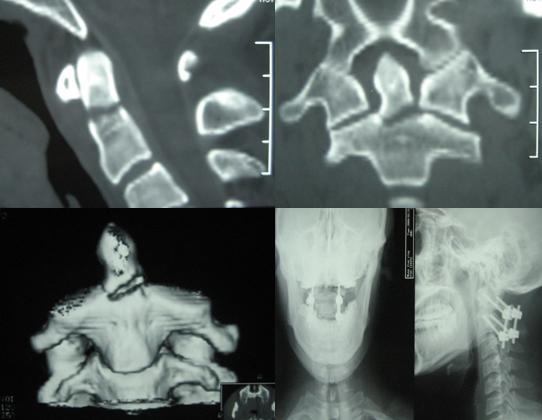 不損傷脊髓的頸椎骨折脫位
