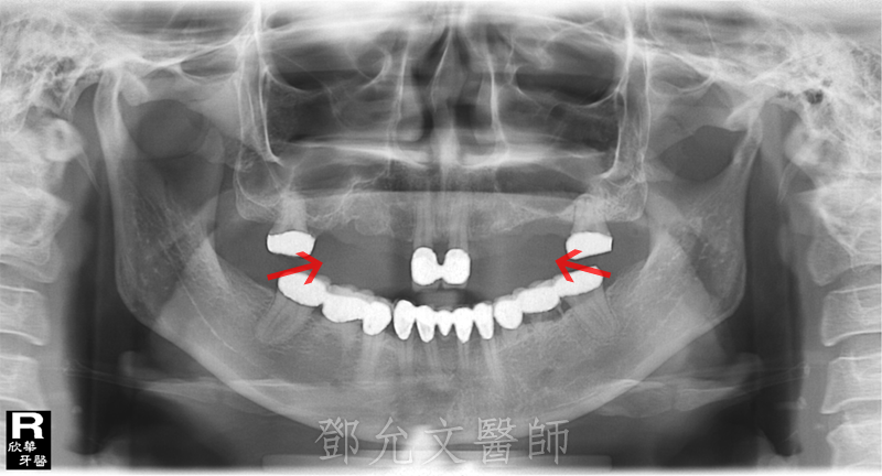 先天缺牙