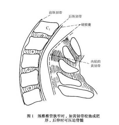 頸椎椎管狹窄