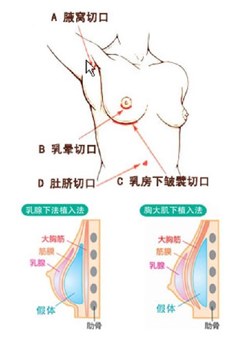 假體隆胸示意圖