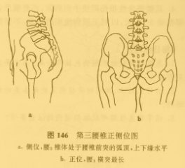 腰三橫突綜合徵