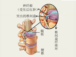 頸腰椎病狀