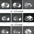 磁共振彌散加權成像