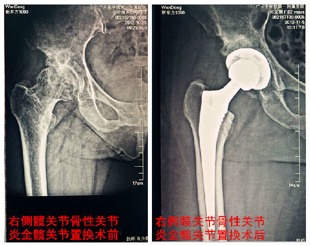 髖關節置換