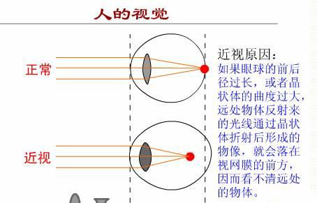 準分子雷射治近視眼手術