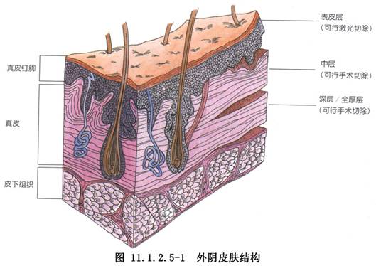 單純女陰切除術