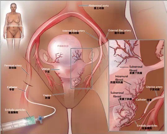 子宮肌瘤併發症