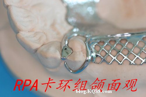 RPA 卡環