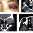 眼眶惡性腫瘤