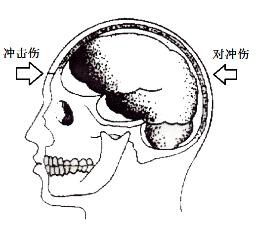 鈍性衝擊傷