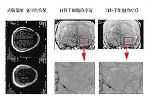 高血壓性腦病診斷