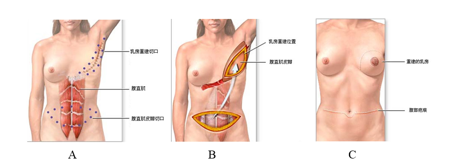 乳房假體
