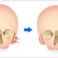 顴骨整形