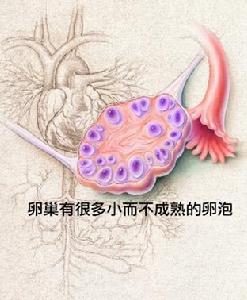 卵巢多發性囊腫