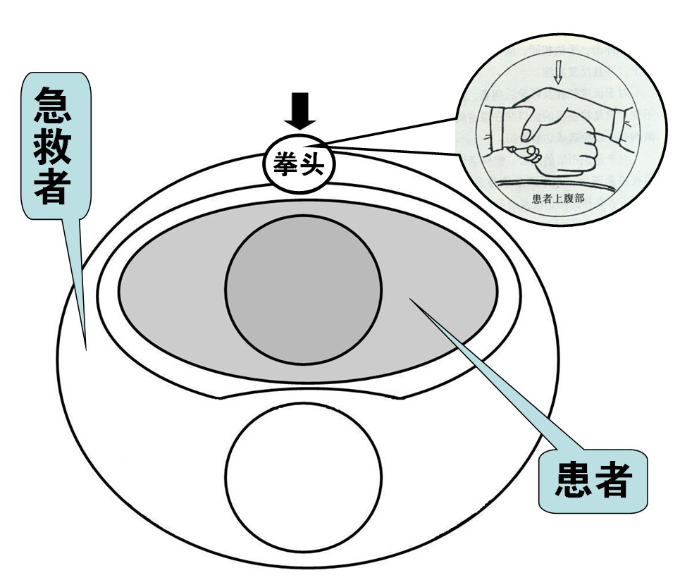 海姆里克腹部衝擊法