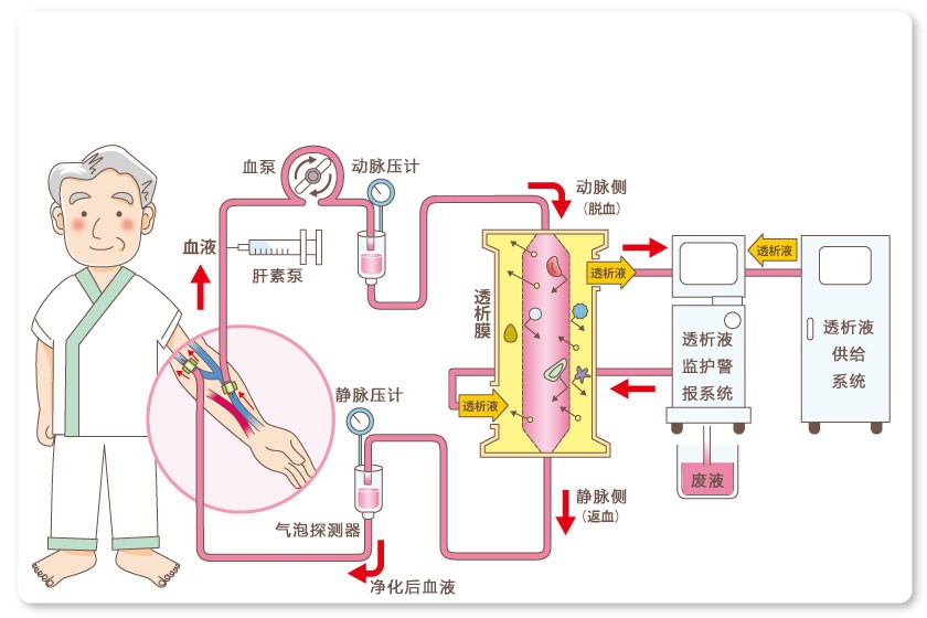 血液透析裝置工作原理