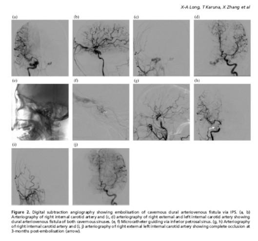 Onyx經靜脈途徑治療海綿竇區硬腦膜動靜脈瘺