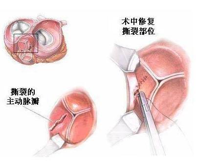 風濕性多肌病