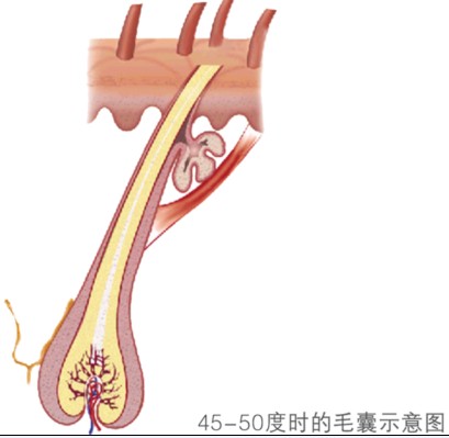 冰點脫毛機理