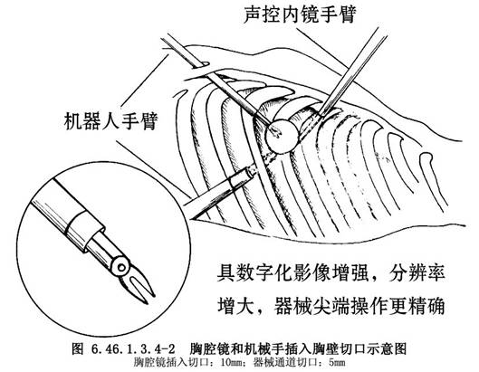 機器人輔助的胸腔鏡CABG