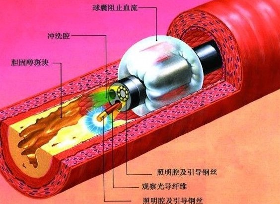 圖2 血管內窺鏡構造圖