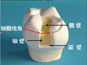 窩洞充填術