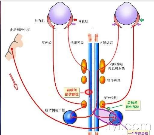 核間性眼肌癱瘓