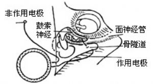 圖4 接收器及其電極植入術