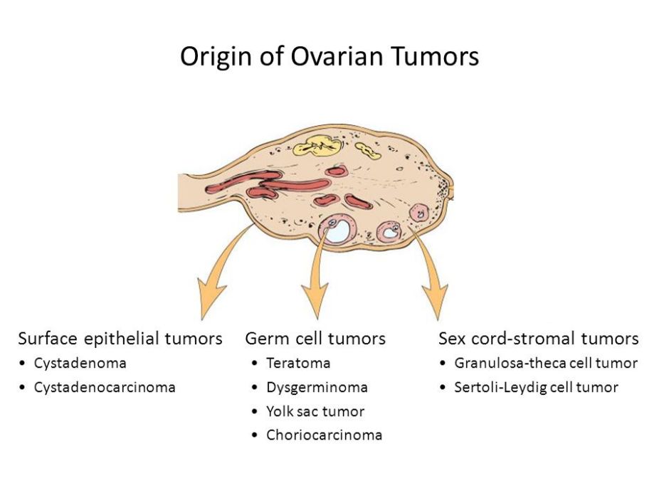卵巢生殖細胞腫瘤