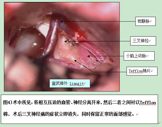 三叉神經痛(三叉神經疼)